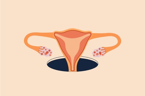 Polycystic ovary syndrome (PCOS)