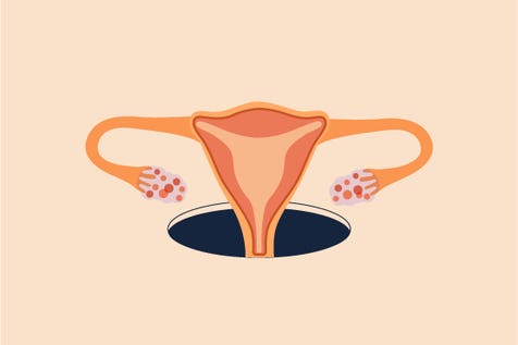 Polycystic ovary syndrome (PCOS)