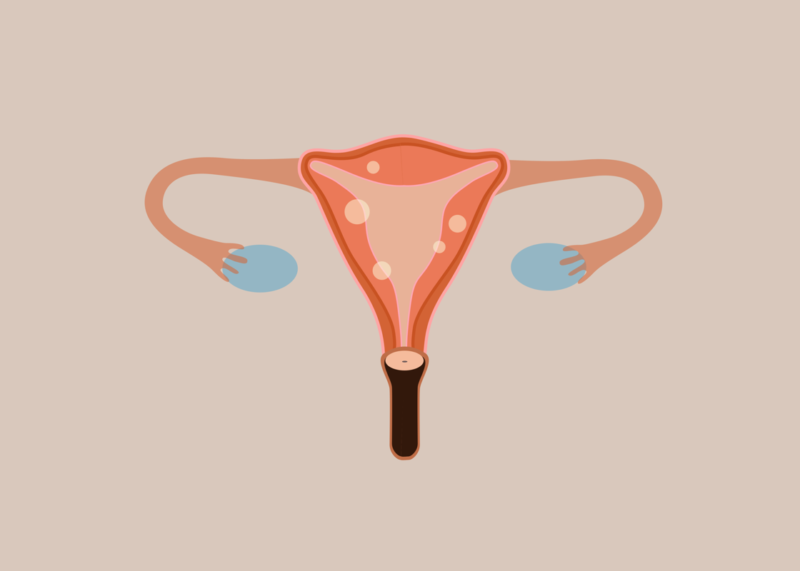 My Bumpy Ride Managing Uterine Fibroids