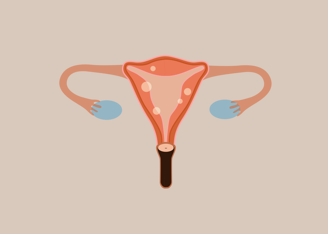 Managing Uterine Fibroids