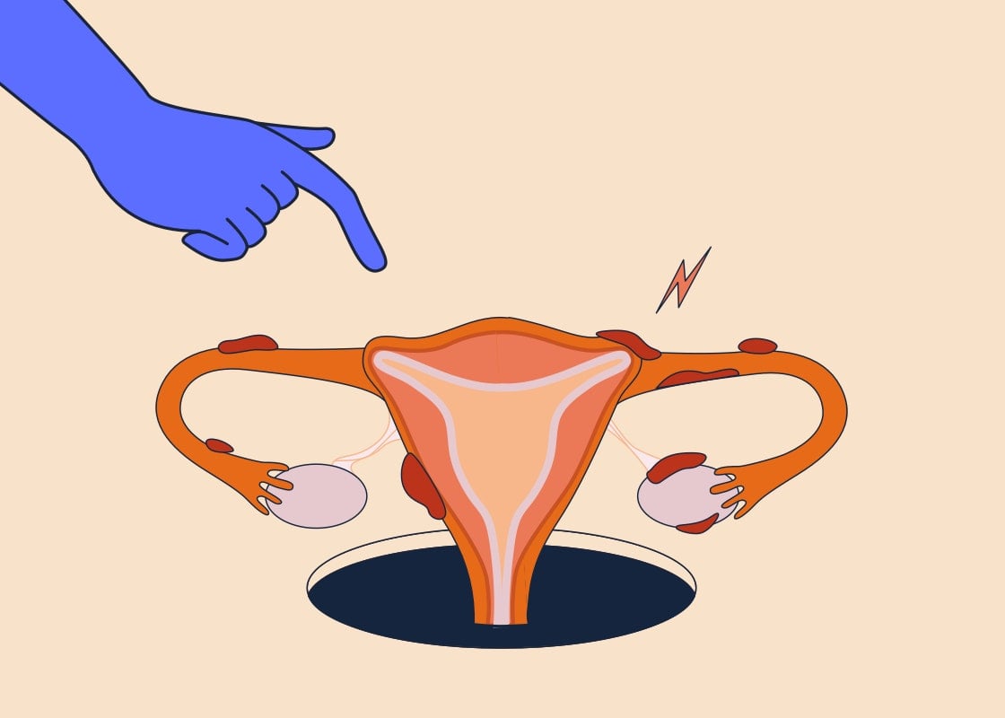 What is endometriosis and how does it affect fertility?